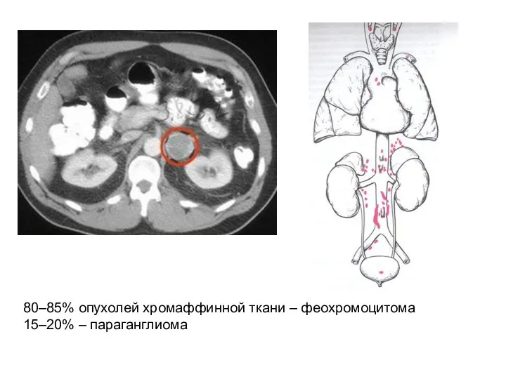 80–85% опухолей хромаффинной ткани – феохромоцитома 15–20% – параганглиома