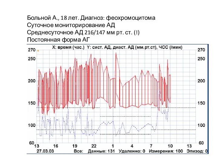 Больной А., 18 лет. Диагноз: феохромоцитома Суточное мониторирование АД Среднесуточное