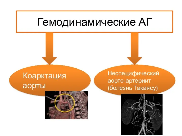 Гемодинамические АГ Коарктация аорты Неспецифический аорто-артериит (болезнь Такаясу)