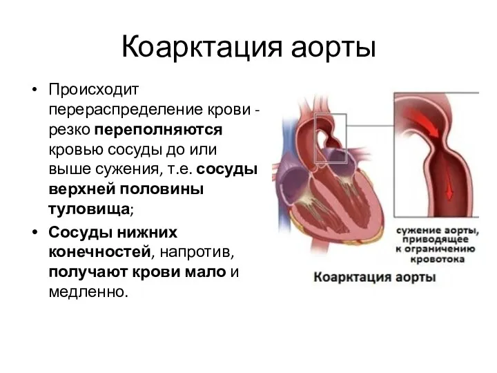 Коарктация аорты Происходит перераспределение крови - резко переполняются кровью сосуды