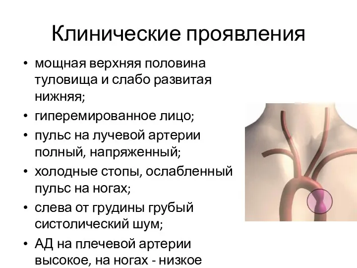 Клинические проявления мощная верхняя половина туловища и слабо развитая нижняя;