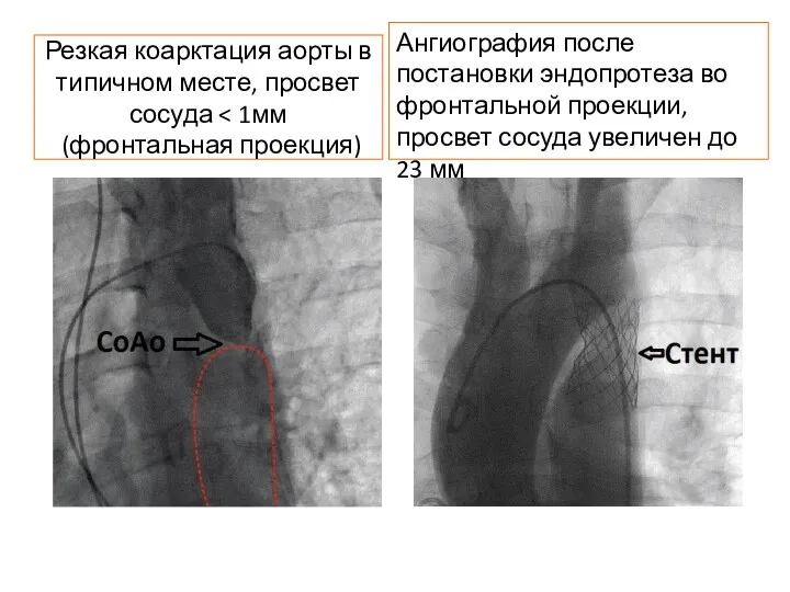 Резкая коарктация аорты в типичном месте, просвет сосуда Ангиография после