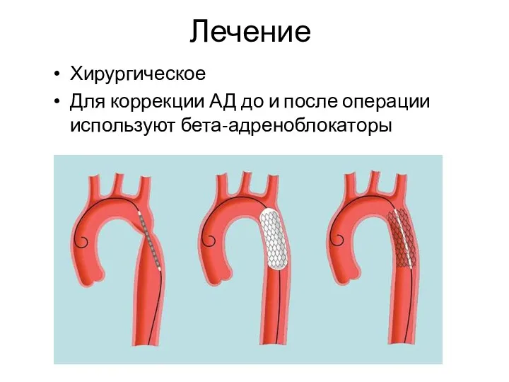 Лечение Хирургическое Для коррекции АД до и после операции используют бета-адреноблокаторы