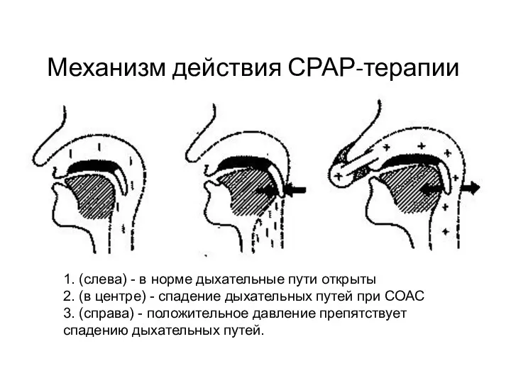 Механизм действия СРАР-терапии 1. (слева) - в норме дыхательные пути