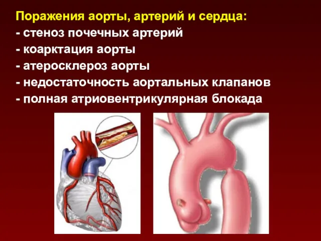 Поражения аорты, артерий и сердца: - стеноз почечных артерий -