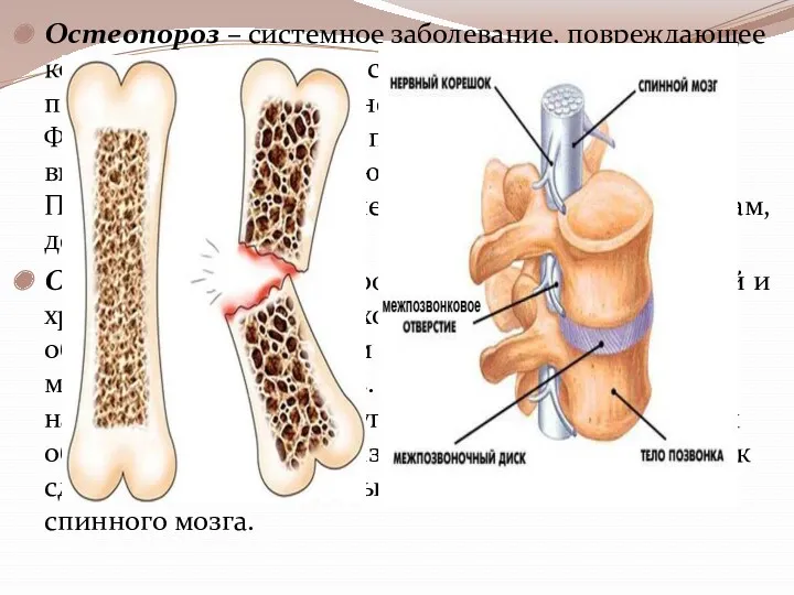 Остеопороз – системное заболевание, повреждающее кости, снижая их плотность и