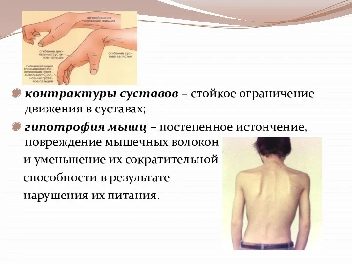 контрактуры суставов – стойкое ограничение движения в суставах; гипотрофия мышц