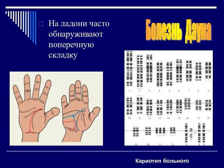 На ладони часто обнаруживают поперечную складку Болезнь Дауна Кариотип больного