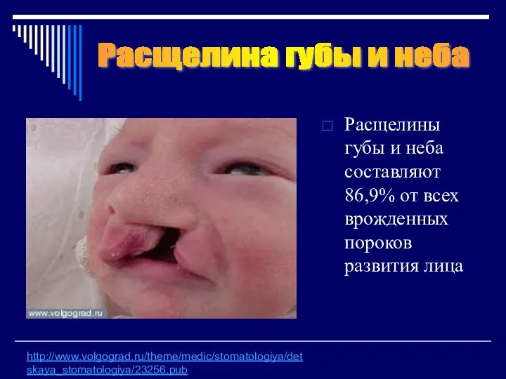 Расщелины губы и неба составляют 86,9% от всех врожденных пороков развития лица http://www.volgograd.ru/theme/medic/stomatologiya/detskaya_stomatologiya/23256.pub