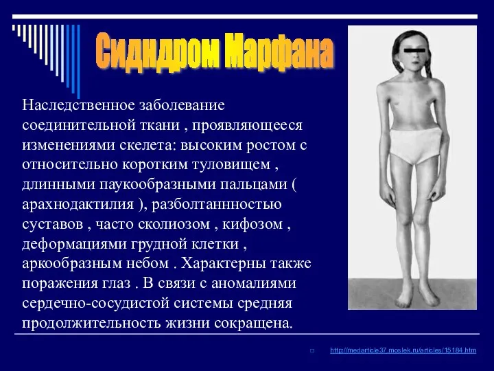 http://medarticle37.moslek.ru/articles/15184.htm Сидндром Марфана Наследственное заболевание соединительной ткани , проявляющееся изменениями скелета: высоким ростом