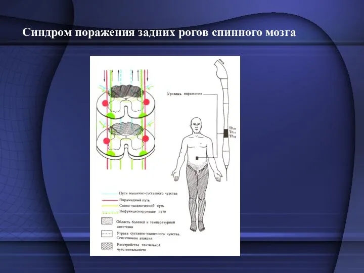 Синдром поражения задних рогов спинного мозга