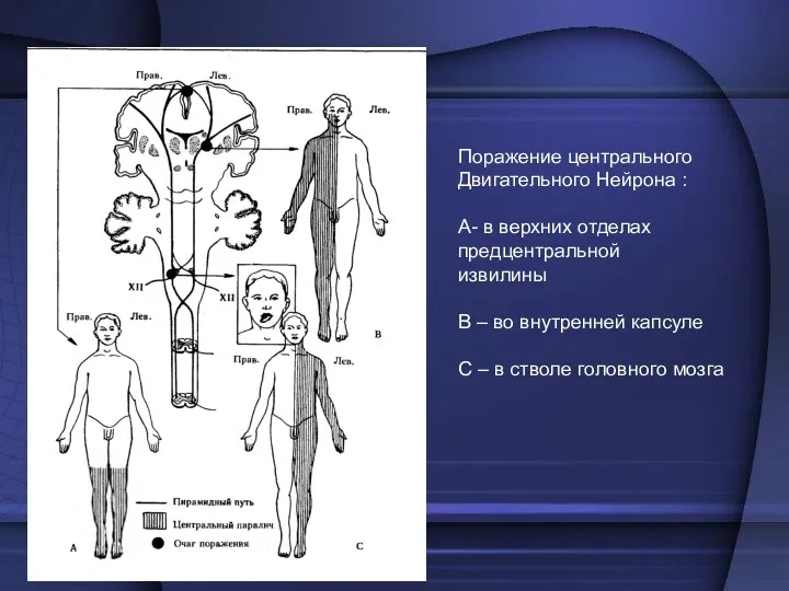 Поражение центрального Двигательного Нейрона : А- в верхних отделах предцентральной