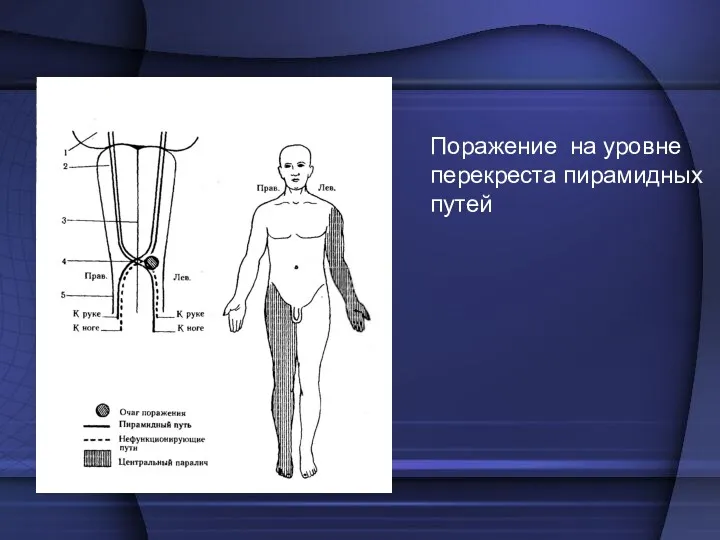 Поражение на уровне перекреста пирамидных путей