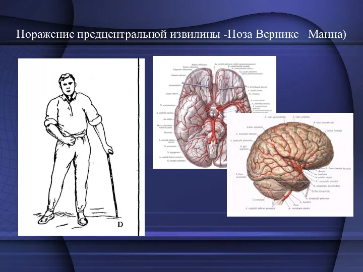 Поражение предцентральной извилины -Поза Вернике –Манна)