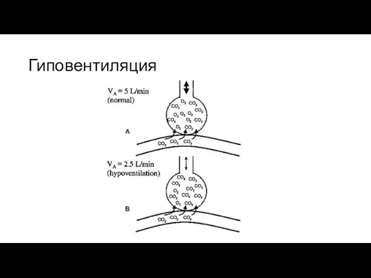 Гиповентиляция