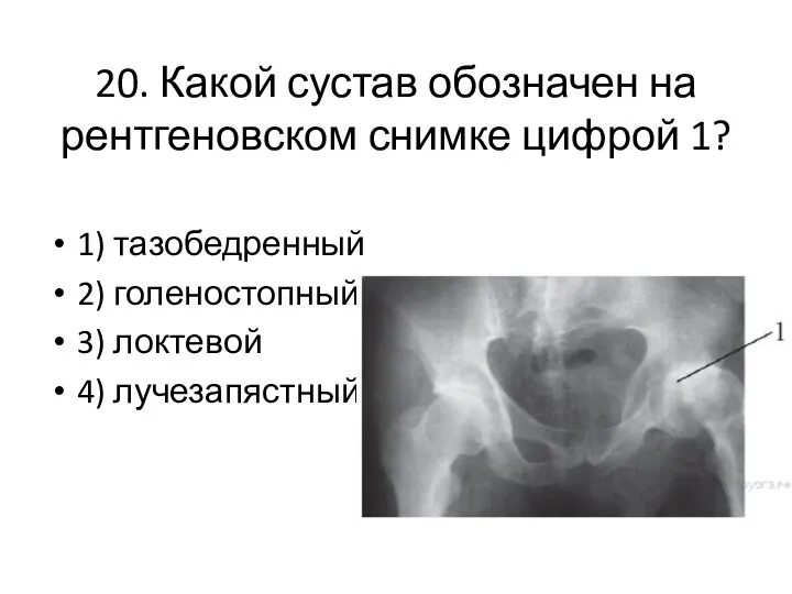 20. Какой сустав обозначен на рентгеновском снимке цифрой 1? 1) тазобедренный 2) голеностопный