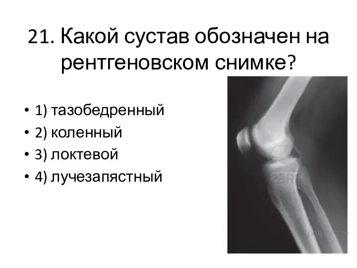 21. Какой сустав обозначен на рентгеновском снимке? 1) тазобедренный 2) коленный 3) локтевой 4) лучезапястный