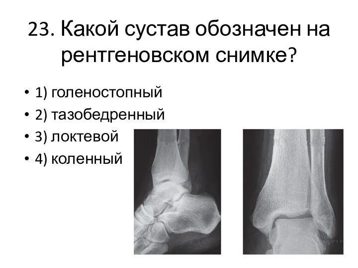 23. Какой сустав обозначен на рентгеновском снимке? 1) голеностопный 2) тазобедренный 3) локтевой 4) коленный