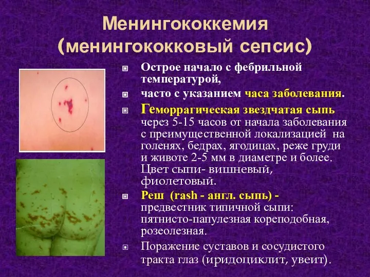 Менингококкемия (менингококковый сепсис) Острое начало с фебрильной температурой, часто с