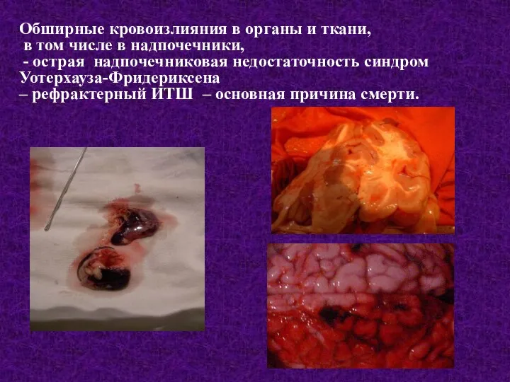 Обширные кровоизлияния в органы и ткани, в том числе в надпочечники, - острая