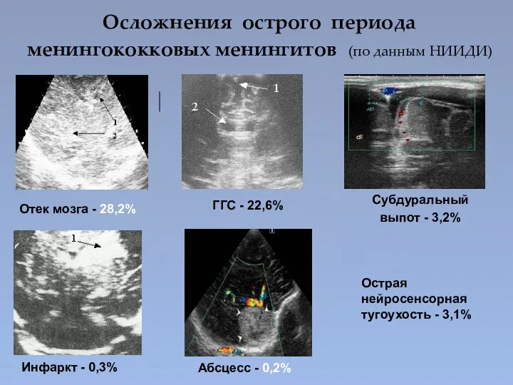 Осложнения острого периода менингококковых менингитов (по данным НИИДИ) Отек мозга