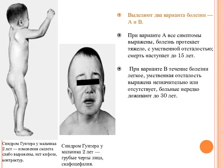 Синдром Гунтера у мальчика 2 лет — грубые черты лица,