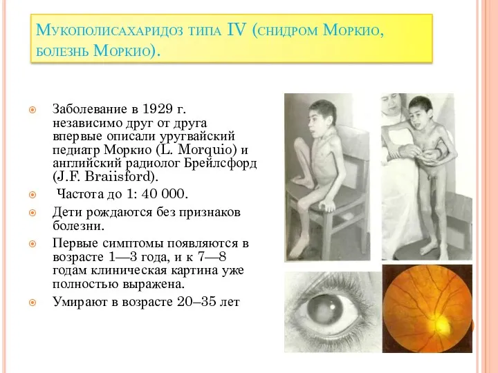 Мукополисахаридоз типа IV (снидром Моркио, болезнь Моркио). Заболевание в 1929