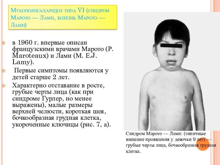 Мукополисахаридоз типа VI (синдром Марото — Лами, болезнь Марото —
