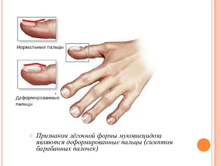 Признаком лёгочной формы муковисцидоза являются деформированные пальцы (симптом барабанных палочек)
