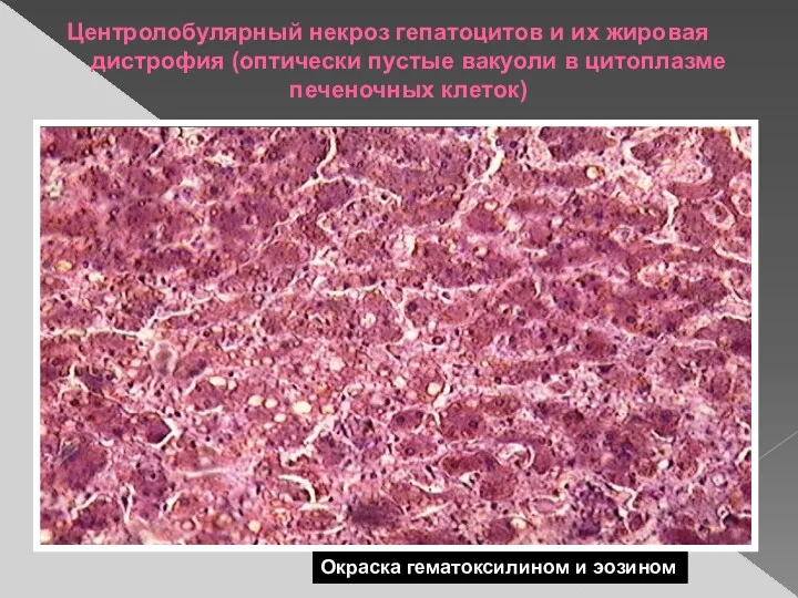 Центролобулярный некроз гепатоцитов и их жировая дистрофия (оптически пустые вакуоли в цитоплазме печеночных