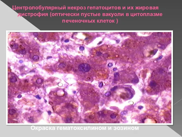 Центролобулярный некроз гепатоцитов и их жировая дистрофия (оптически пустые вакуоли в цитоплазме печеночных