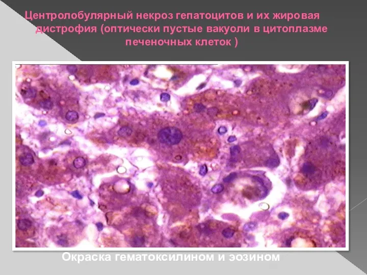 Центролобулярный некроз гепатоцитов и их жировая дистрофия (оптически пустые вакуоли