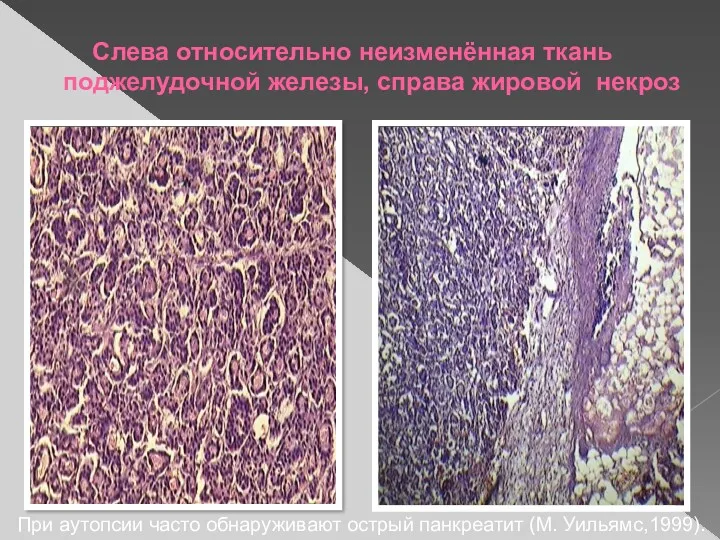 Слева относительно неизменённая ткань поджелудочной железы, справа жировой некроз При аутопсии часто обнаруживают