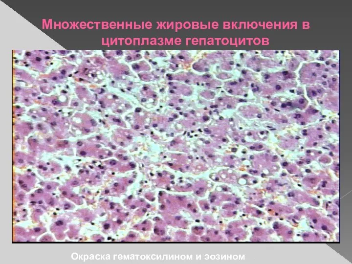 Множественные жировые включения в цитоплазме гепатоцитов Окраска гематоксилином и эозином