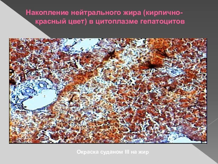 Накопление нейтрального жира (кирпично-красный цвет) в цитоплазме гепатоцитов Окраска суданом III на жир