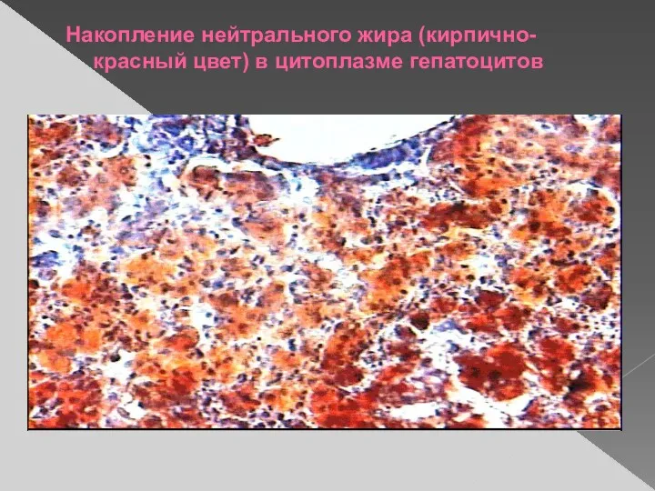 Накопление нейтрального жира (кирпично-красный цвет) в цитоплазме гепатоцитов