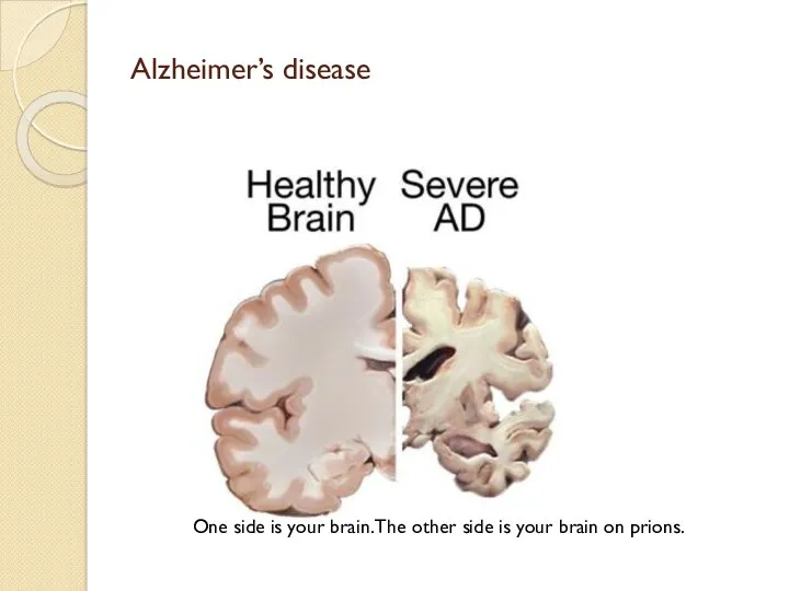 Alzheimer’s disease One side is your brain. The other side is your brain on prions.