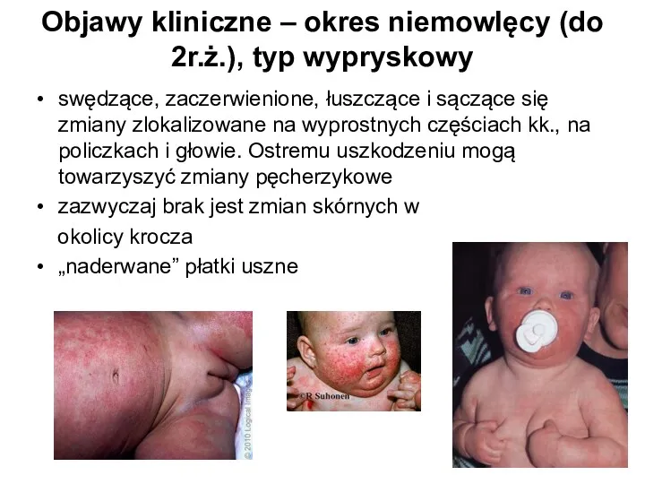 Objawy kliniczne – okres niemowlęcy (do 2r.ż.), typ wypryskowy swędzące,