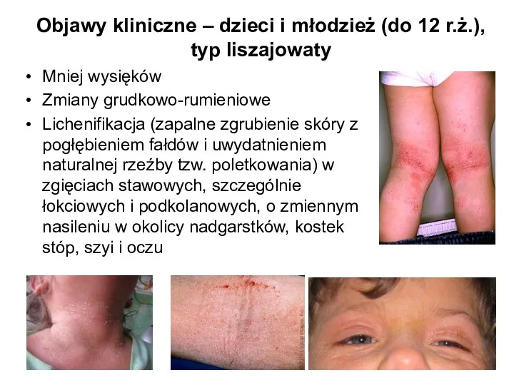 Objawy kliniczne – dzieci i młodzież (do 12 r.ż.), typ