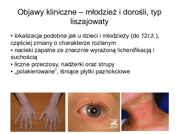 Objawy kliniczne – młodzież i dorośli, typ liszajowaty • lokalizacja