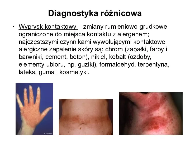 Diagnostyka różnicowa Wyprysk kontaktowy – zmiany rumieniowo-grudkowe ograniczone do miejsca