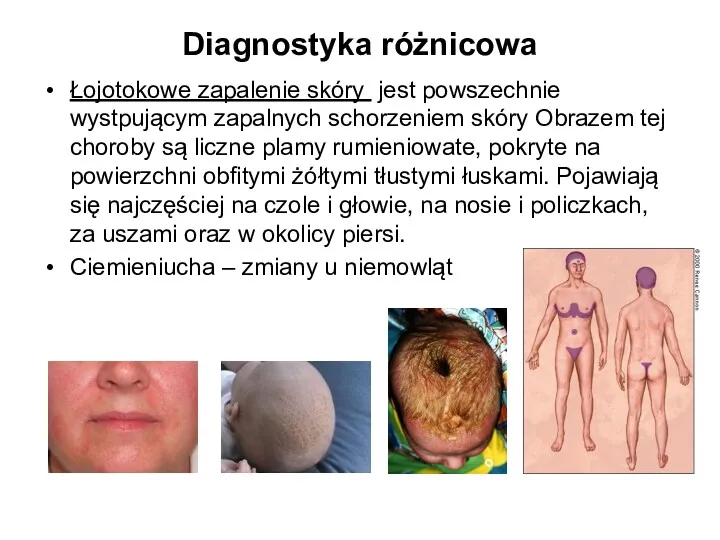 Diagnostyka różnicowa Łojotokowe zapalenie skóry jest powszechnie wystpującym zapalnych schorzeniem