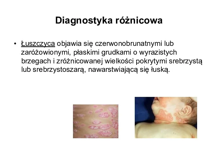 Diagnostyka różnicowa Łuszczyca objawia się czerwonobrunatnymi lub zaróżowionymi, płaskimi grudkami