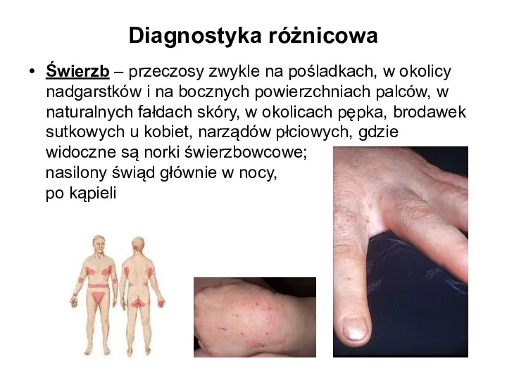 Diagnostyka różnicowa Świerzb – przeczosy zwykle na pośladkach, w okolicy