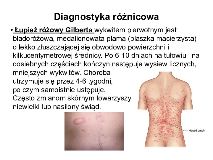 Diagnostyka różnicowa Łupież różowy Gilberta wykwitem pierwotnym jest bladoróżowa, medalionowata