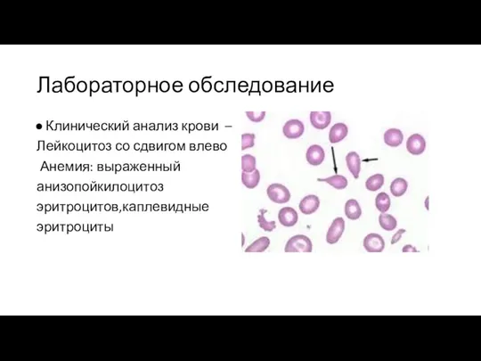 Лабораторное обследование Клинический анализ крови – Лейкоцитоз со сдвигом влево Анемия: выраженный анизопойкилоцитоз эритроцитов,каплевидные эритроциты