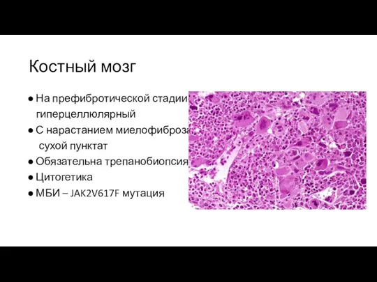 Костный мозг На префибротической стадии- гиперцеллюлярный С нарастанием миелофиброза – сухой пунктат Обязательна