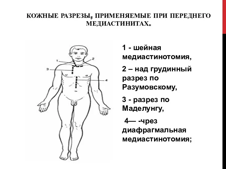 КОЖНЫЕ РАЗРЕЗЫ, ПРИМЕНЯЕМЫЕ ПРИ ПЕРЕДНЕГО МЕДИАСТИНИТАХ. 1 - шейная медиастинотомия,