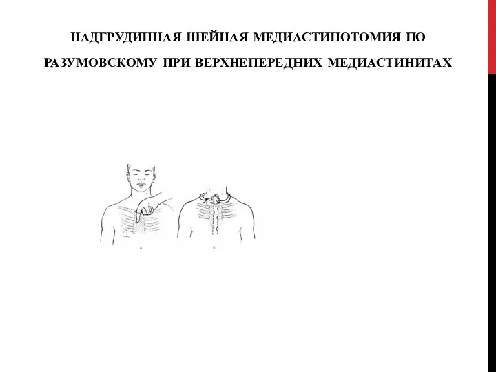 НАДГРУДИННАЯ ШЕЙНАЯ МЕДИАСТИНОТОМИЯ ПО РАЗУМОВСКОМУ ПРИ ВЕРХНЕПЕРЕДНИХ МЕДИАСТИНИТАХ