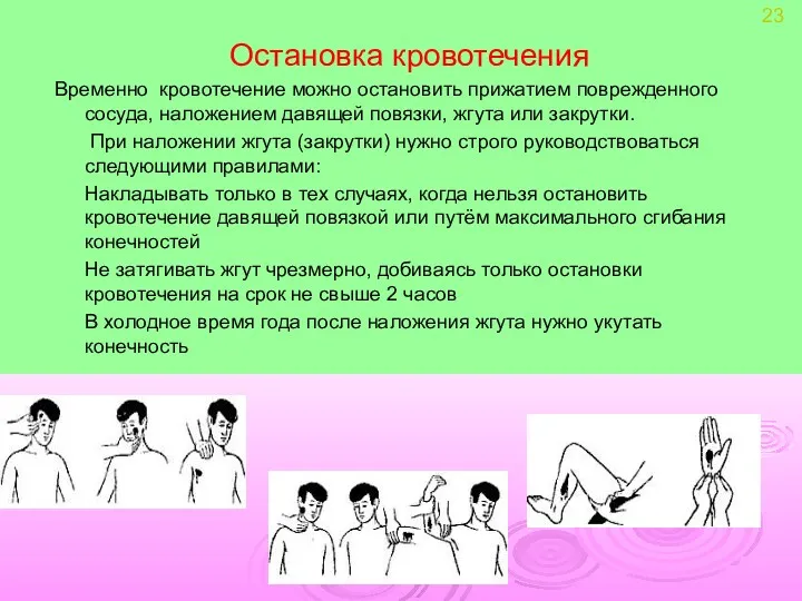 Остановка кровотечения Временно кровотечение можно остановить прижатием поврежденного сосуда, наложением